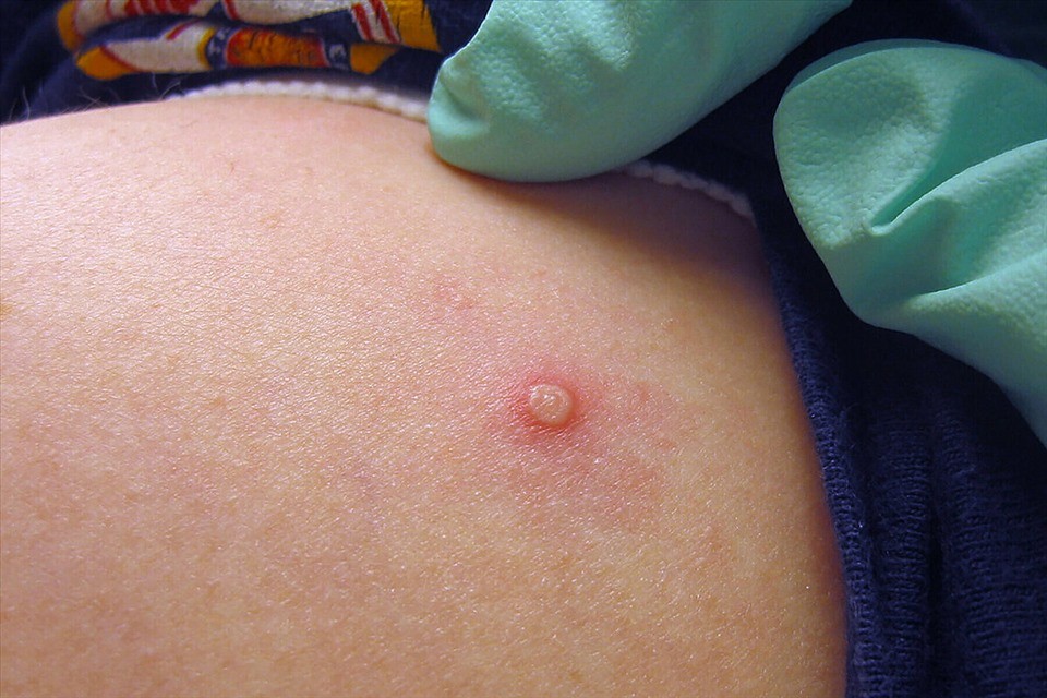 Bệnh nhân mắc bệnh đậu mùa khỉ đầu tiên tại Việt Nam được xuất viện