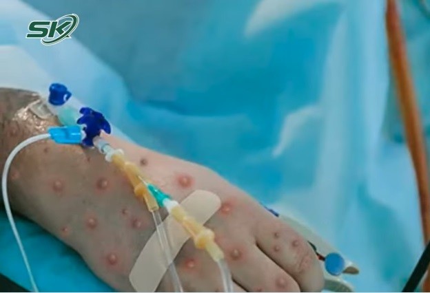 Bệnh đậu mùa khỉ có thể lây truyền trước khi xuất hiện các triệu chứng Bệnh đậu mùa khỉ có thể lây truyền trước khi xuất hiện các triệu chứng