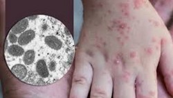 Bộ Y tế xếp bệnh đậu mùa khỉ vào bệnh truyền nhiễm nhóm B