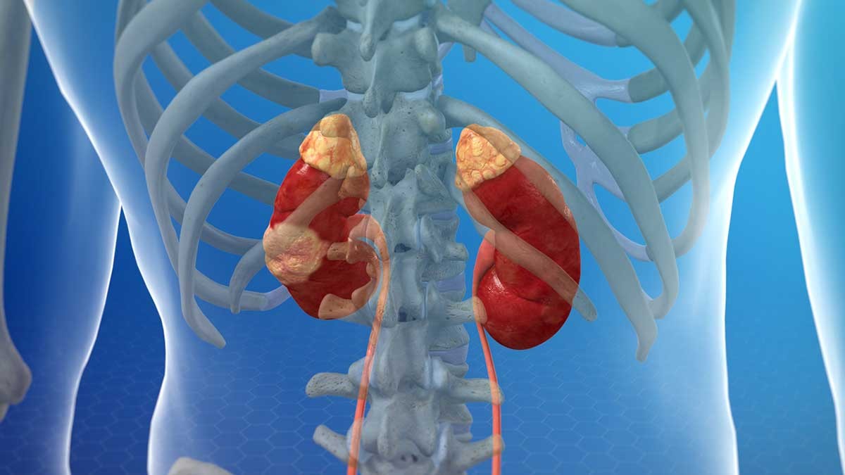 Ung thư thận có dấu hiệu sớm không? (Nguồn: GHV Ksol)