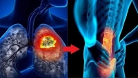 5 triệu chứng cảnh báo ung thư phổi di căn xương cần biết