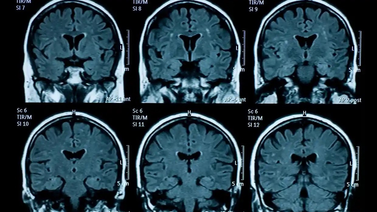 dau hieu lao hoa som o nao bo thanh thieu nien sau dai dich covid19