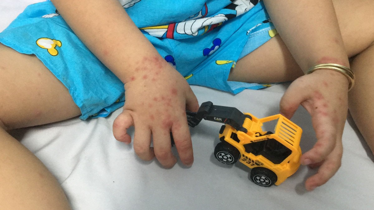 6 khuyen cao phong chong benh tay chan mieng nang bien chung nguy hiem o tre em