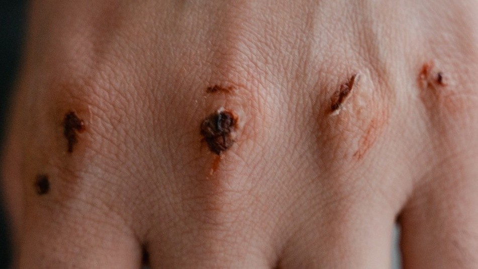 Sử dụng điện giúp tăng tốc phục hồi vết thương