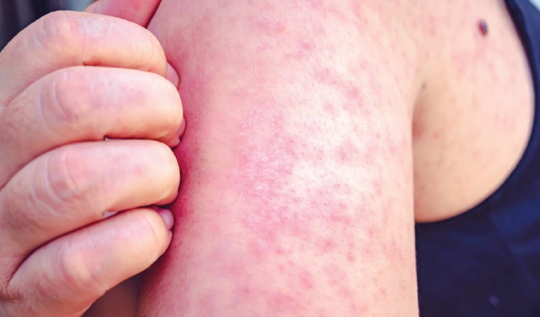 Australia cảnh báo khả năng bùng phát bệnh sởi