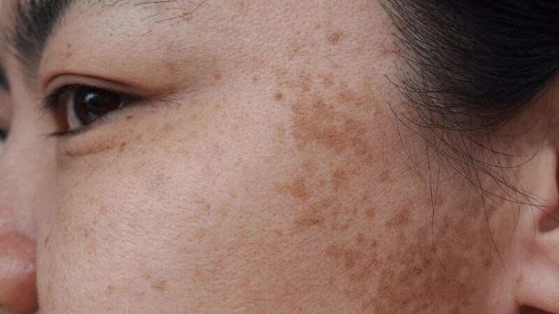 Sử dụng Hi Beauty có hết được nám, sạm?