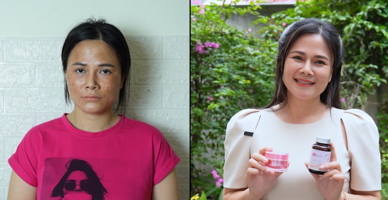 Sử dụng Hi Beauty có hết được nám, sạm?