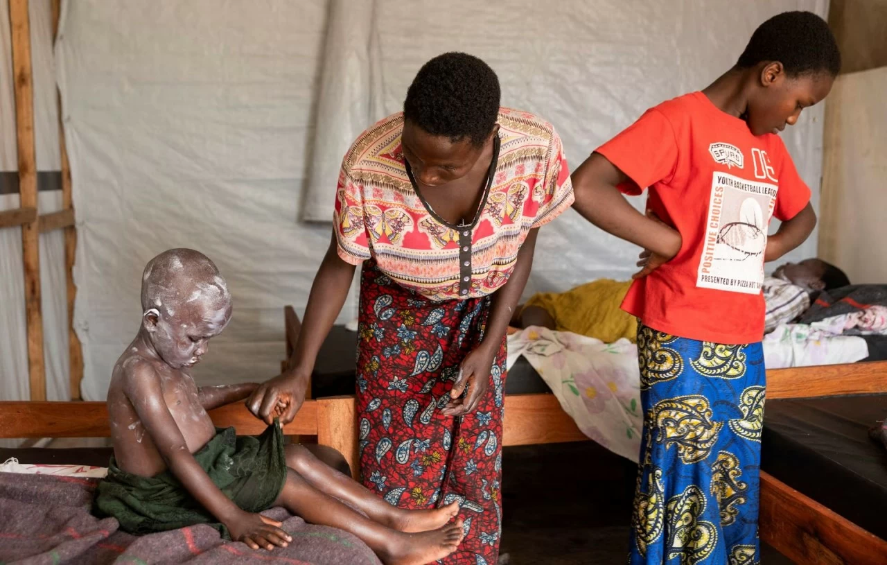 Hình ảnh tuyến đầu của đợt bùng phát bệnh đầu mùa khỉ nghiêm trọng ở Congo Hình ảnh tuyến đầu của đợt bùng phát bệnh đầu mùa khỉ nghiêm trọng ở Congo