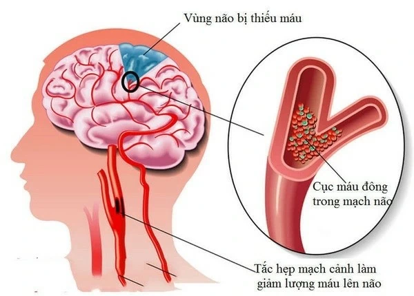 Chuyên gia tư vấn về nguyên nhân và biện pháp giảm nguy cơ thiếu máu lên não Chuyên gia tư vấn về nguyên nhân và biện pháp giảm nguy cơ thiếu máu lên não