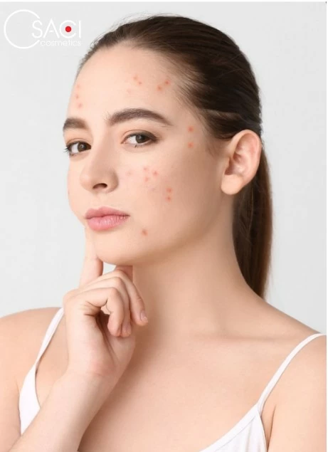 Da mụn khiến chị em cảm thấy tự ti - Hình ảnh minh hoạ Da mụn khiến chị em cảm thấy tự ti - Hình ảnh minh hoạ