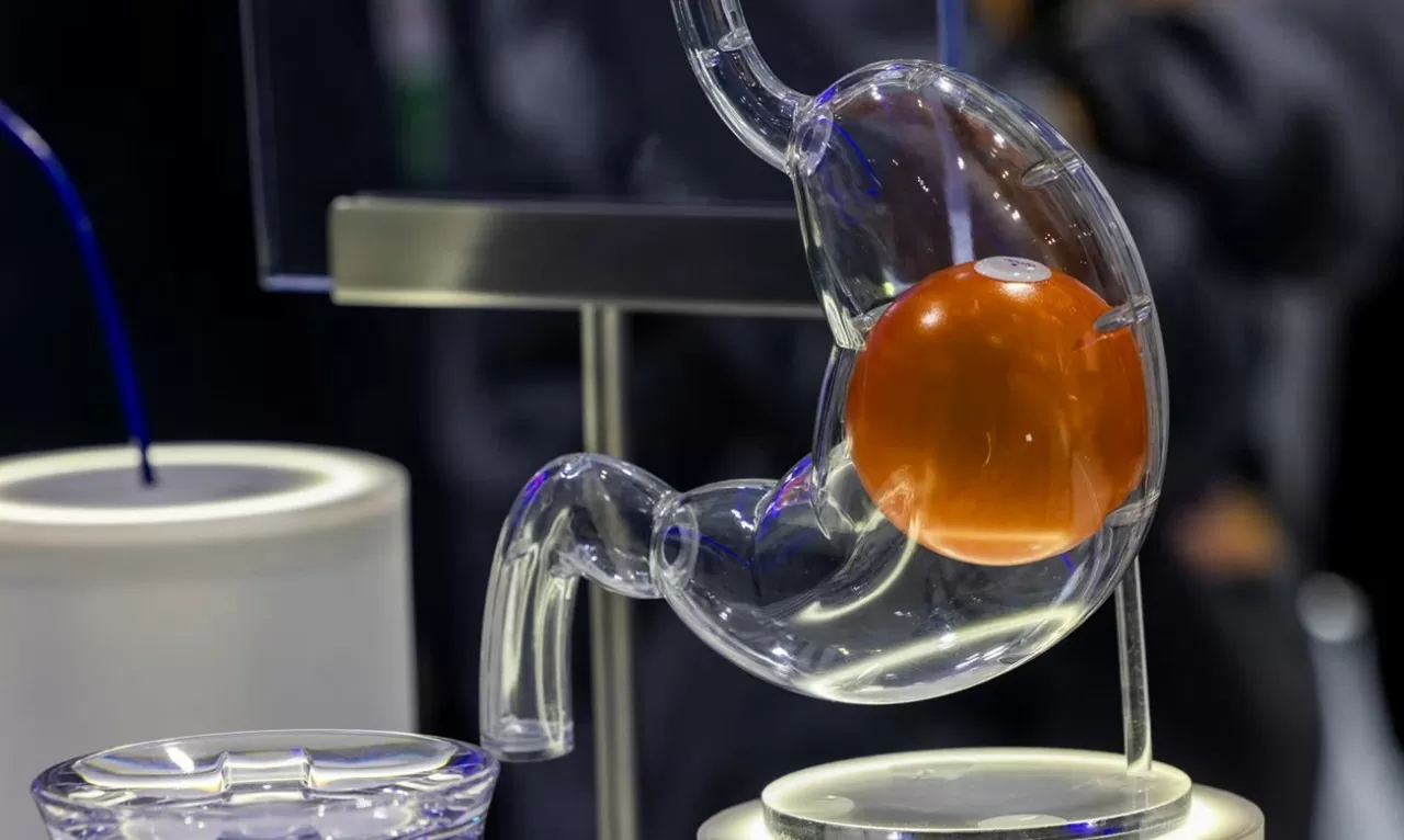 Kiểm soát cân nặng, chống béo phì hiệu quả bằng phương pháp đặt bóng hơi trong dạ dày Kiểm soát cân nặng, chống béo phì hiệu quả bằng phương pháp đặt bóng hơi trong dạ dày