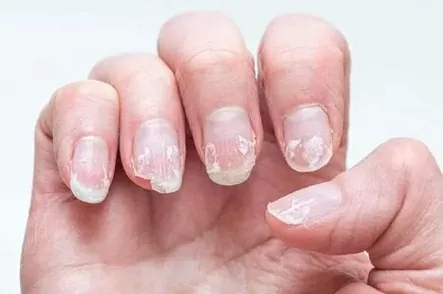 Nếu móng tay có những dấu hiệu này, thì có thể bạn đang thiếu hụt vitamin thiết yếu B12 Nếu móng tay có những dấu hiệu này, thì có thể bạn đang thiếu hụt vitamin thiết yếu B12