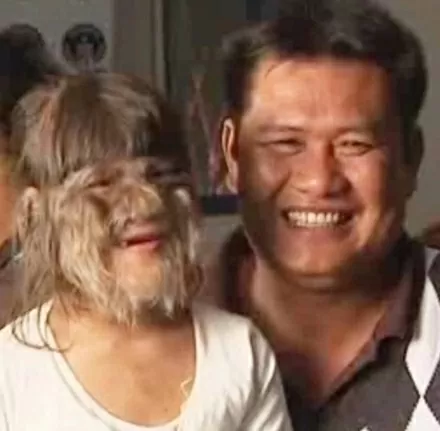 Nghị lực vươn lên của cô gái trẻ mắc 'hội chứng người sói' Nghị lực vươn lên của cô gái trẻ mắc 'hội chứng người sói'