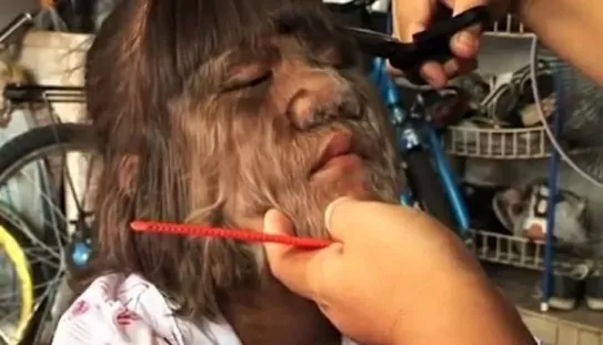 Nghị lực vươn lên của cô gái trẻ mắc 'hội chứng người sói' Nghị lực vươn lên của cô gái trẻ mắc 'hội chứng người sói'