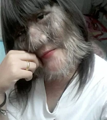 Nghị lực vươn lên của cô gái trẻ mắc 'hội chứng người sói' Nghị lực vươn lên của cô gái trẻ mắc 'hội chứng người sói'