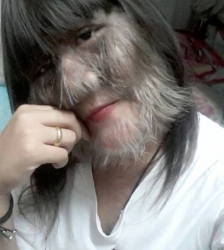 Câu chuyện truyền cảm hứng về lối sống tốt đẹp của cô gái mắc 'hội chứng người sói'