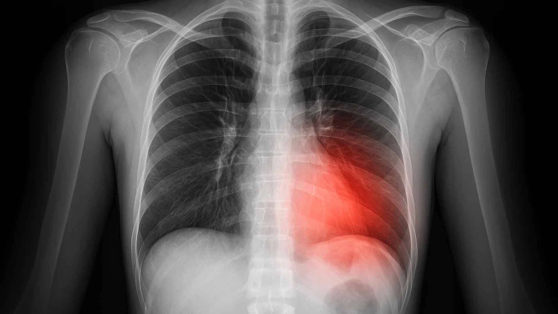 Phát hiện lỗi gene liên quan xẹp phổi và ung thư thận