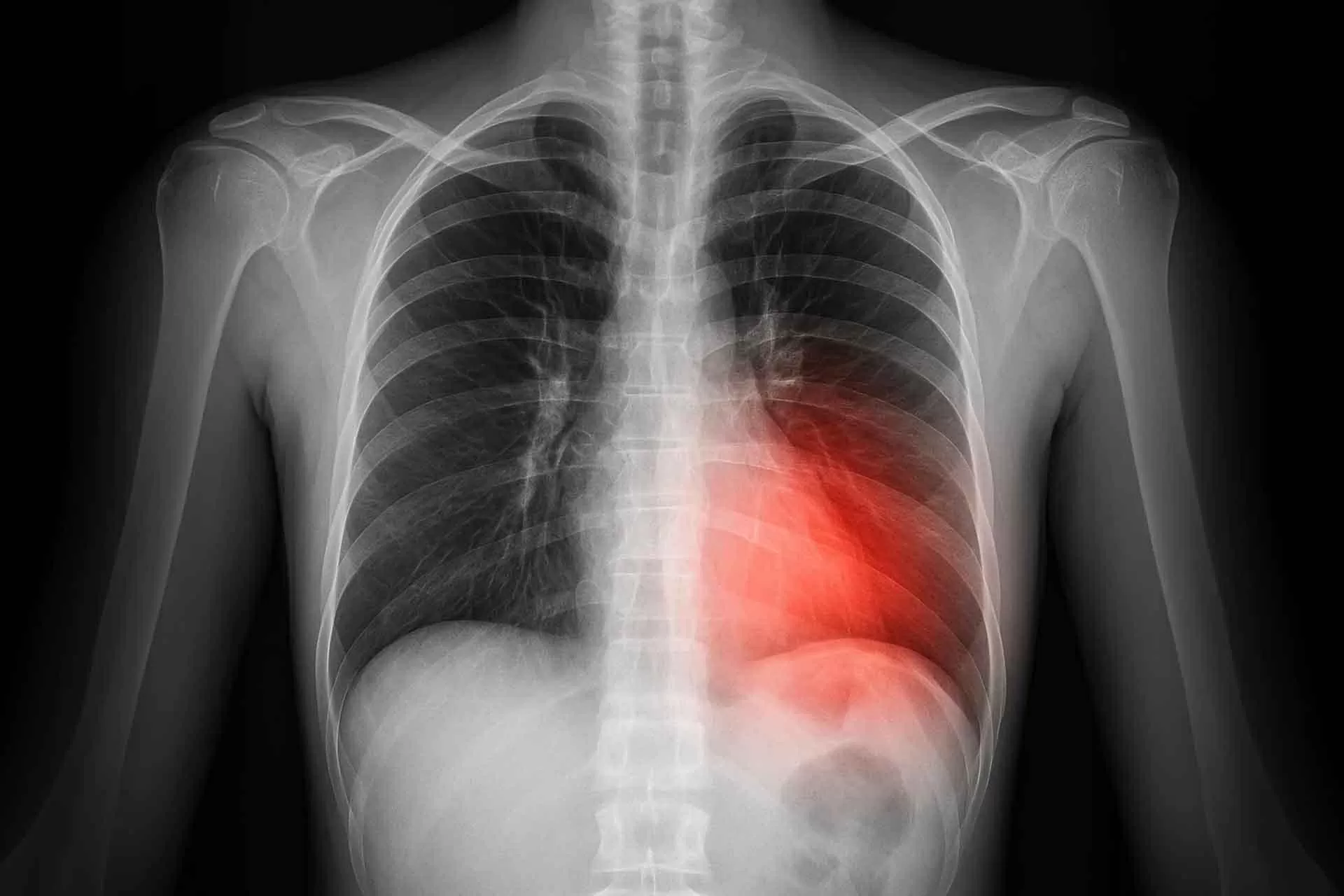 Phát hiện lỗi gene liên quan xẹp phổi và ung thư thận Phát hiện lỗi gene liên quan xẹp phổi và ung thư thận