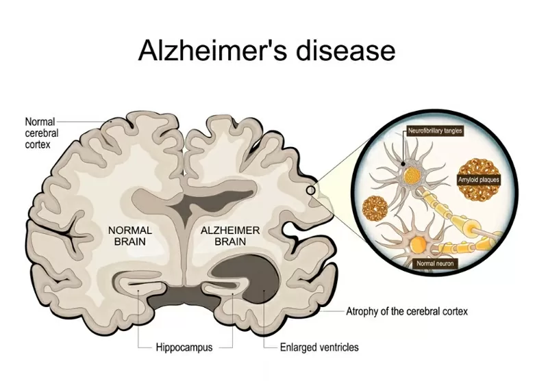 Một số người có mảng bám amyloid và đám rối tau liên quan đến bệnh Alzheimer nhưng không bao giờ mắc chứng mất trí. Minh họa: Shutterstock