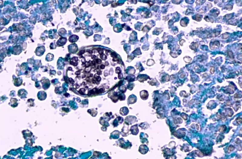 Bệnh nấm da này rất khó điều trị, nguy cơ tử vong cao, phương pháp điều trị còn hạn chế