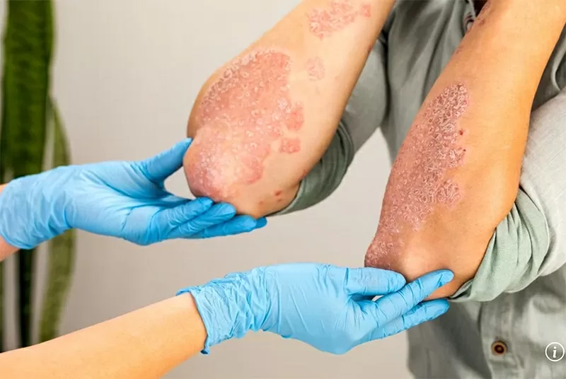 Bệnh nấm da này rất khó điều trị, nguy cơ tử vong cao, phương pháp điều trị còn hạn chế