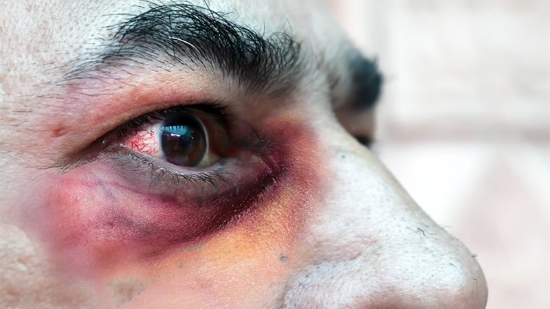 Chú ý: Bệnh nấm da này khó chữa, nguy cơ tử vong cao, phương pháp điều trị còn hạn chế