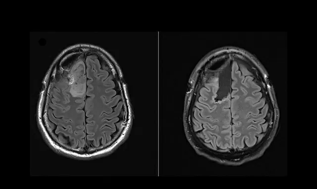 Thử nghiệm lâm sàng lần đầu tiên trên thế giới về phương pháp điều trị u não