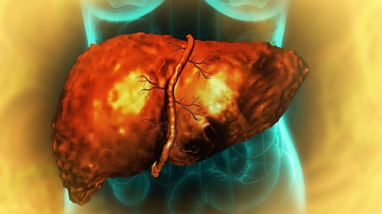 Chế độ ăn nhiều chất béo làm tăng nguy cơ ung thư gan