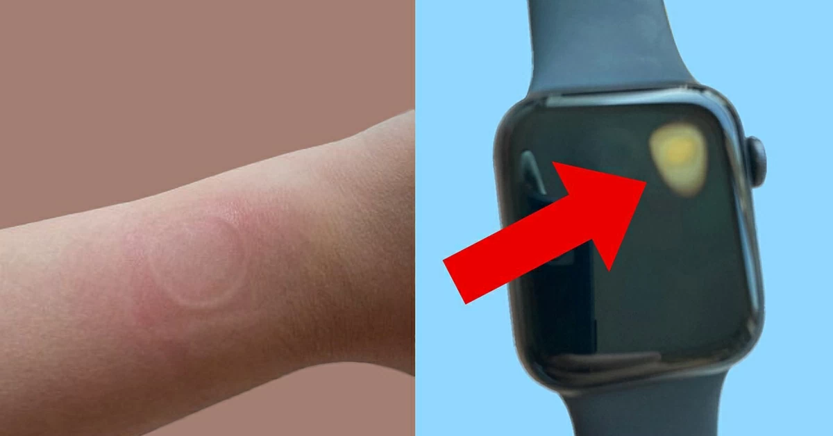 Một người dùng Reddit chia sẻ trải nghiệm bị Apple Watch gây bỏng cổ tay nghiêm trọng. Một người dùng Reddit chia sẻ trải nghiệm bị Apple Watch gây bỏng cổ tay nghiêm trọng.