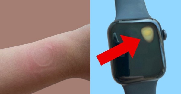 Apple Watch bị nghi quá nhiệt gây bỏng, Apple chưa lên tiếng sau 6 tháng