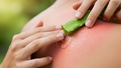 Cách phục hồi làn da bỏng nắng sau khi đi biển