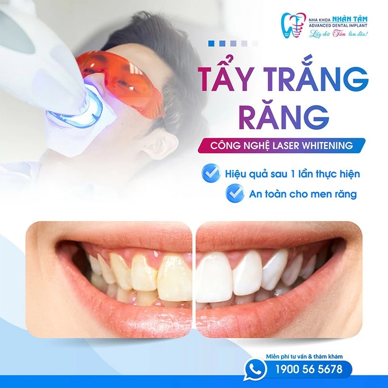 Tẩy trắng răng an toàn tại nha khoa Nhân Tâm. Tẩy trắng răng an toàn tại nha khoa Nhân Tâm.