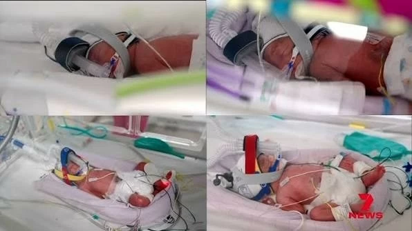 Australia ghi nhận ca sinh 4 cùng trứng tự nhiên siêu hiếm gặp Australia ghi nhận ca sinh 4 cùng trứng tự nhiên siêu hiếm gặp