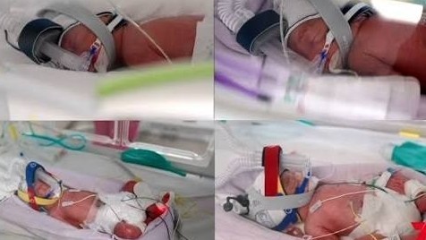 Australia ghi nhận ca sinh 4 cùng trứng tự nhiên siêu hiếm gặp