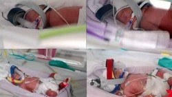 Australia ghi nhận ca sinh 4 cùng trứng tự nhiên siêu hiếm gặp