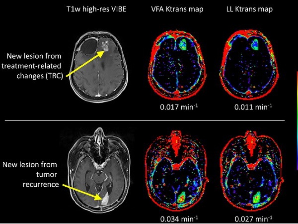 tim ra phuong phap moi chua u nao ma khong can phau thuat