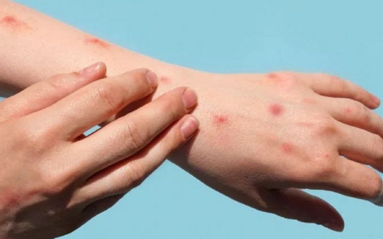 Để chủ động phòng chống dịch bệnh đậu mùa khỉ ở nước ta, Bộ Y tế khuyến cáo người dân chủ động thực hiện các biện pháp phòng bệnh