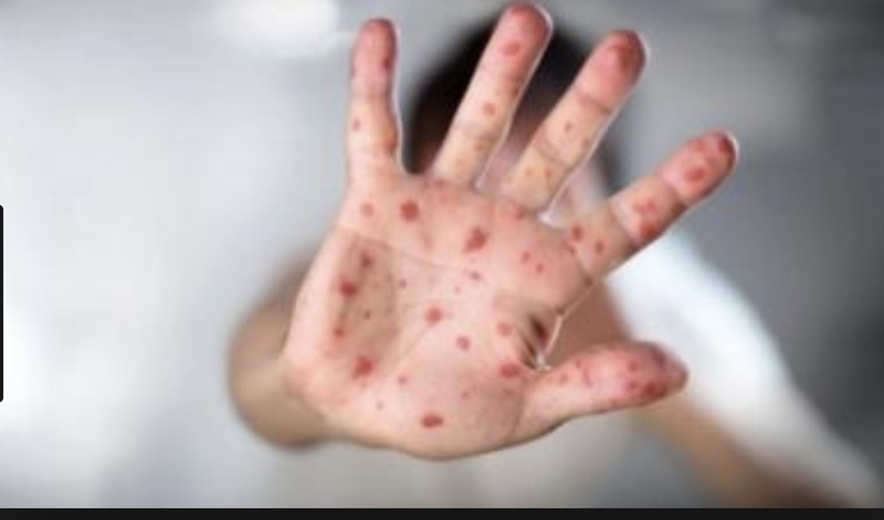 dich soi bung phat do ha ng trie u tre em khong tiem vaccine