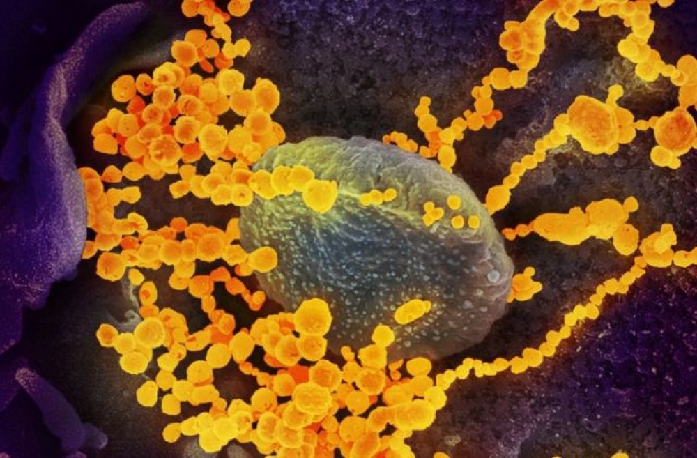 Hình ảnh virus SARS-CoV-2 (màu vàng) nổi lên bề mặt tế bào người. . (Nguồn: Reuters)