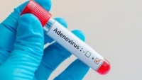 Khi nào nên xét nghiệm virus Adeno?