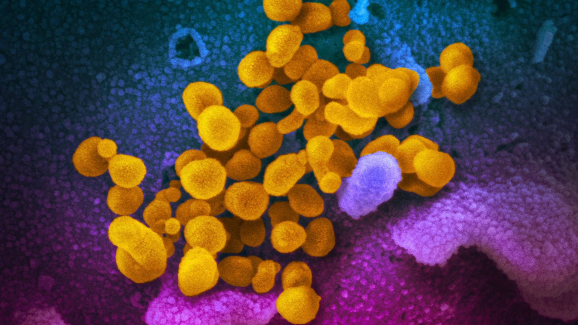 Phát hiện mới: Cơ hội cứu chữa sớm cho những bệnh nhân Covid-19 có nguy cơ chuyển biến nặng phat hien moi co hoi cuu chua som cho nhung benh nhan covid 19 co nguy co chuyen bien nang