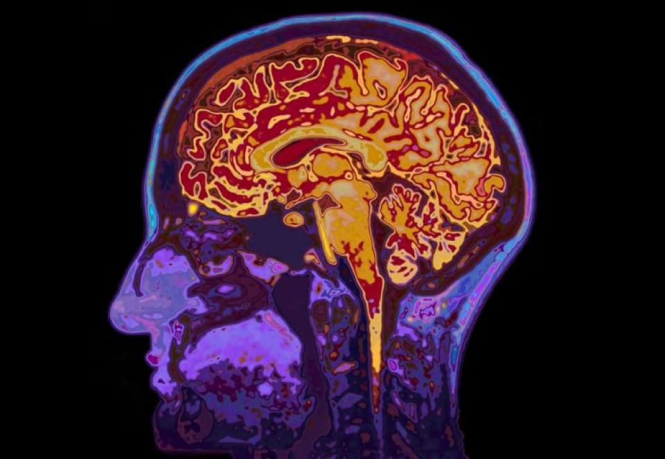 buoc tien lon trong viec dieu tri benh alzheimer