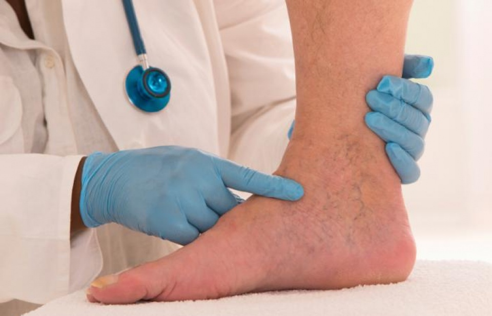 Mỹ: Phương thuốc mới trong điều trị bệnh phù bạch huyết