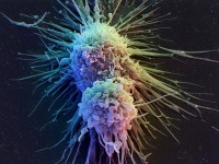 Hy vọng chữa ung thư từ tế bào miễn dịch biến đổi gen