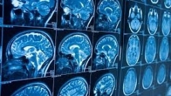 Canada 'hoang mang' vì loạt ca bệnh não bí ẩn gây chết người