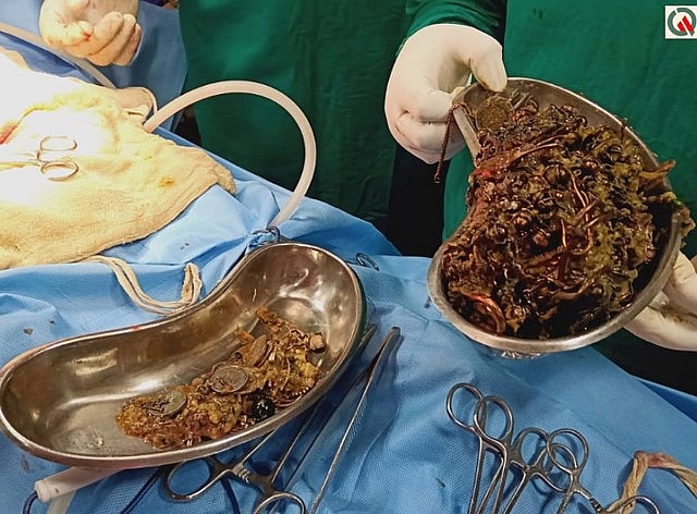 kho bau 15 ty trang suc va tien xu trong bung nu benh nhan 26 tuoi