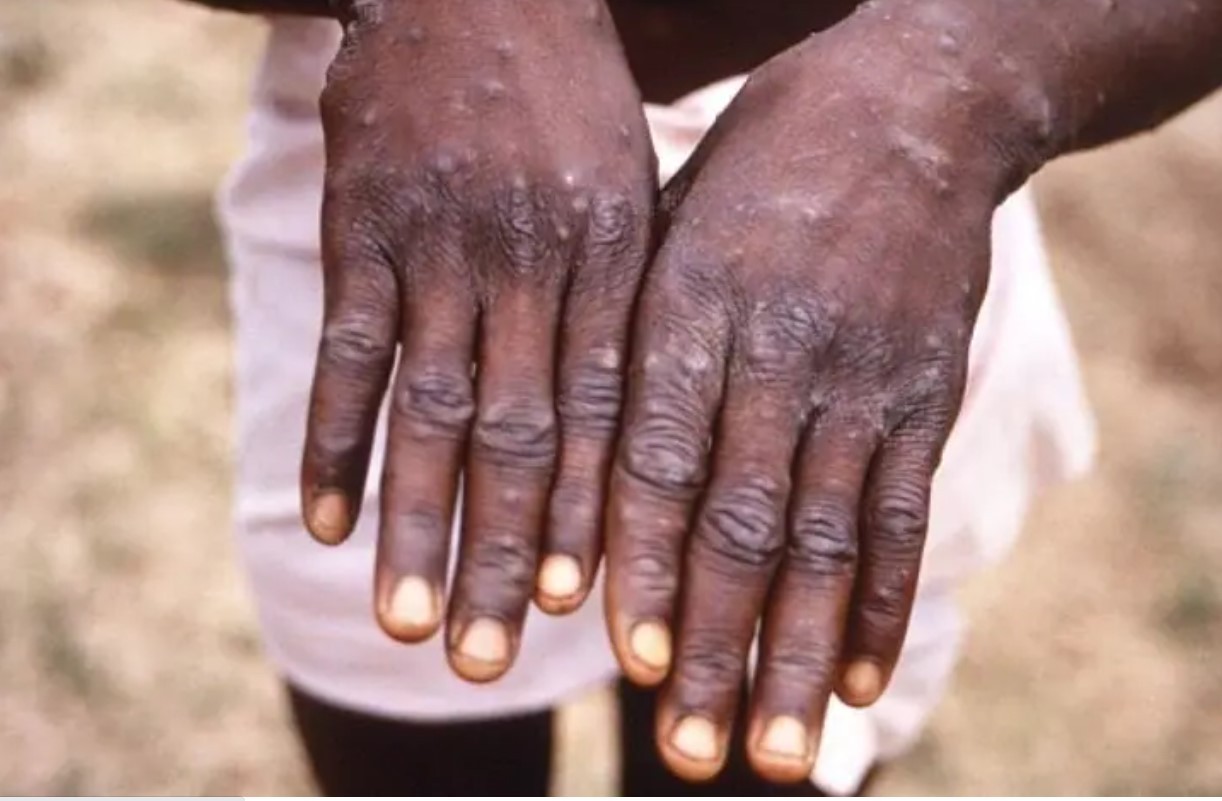 Tổn thương đậu mùa trên bàn tay của người bị nhiễm vrus đậu mùa khỉ. Những người có tiếp xúc thân thể gần gũi với người bị bệnh đậu mùa khỉ, khi họ đang có triệu chứng, có nguy cơ mắc bệnh cao nhất. (Nguồn: Getty Images)