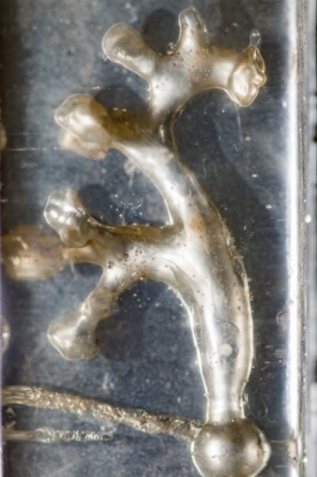 Chữa sỏi thận bằng... tàu lượn siêu tốc