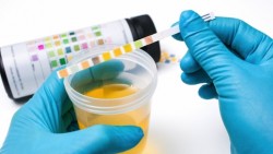 Vì sao không nên bỏ qua xét nghiệm nước tiểu khi khám sức khỏe?