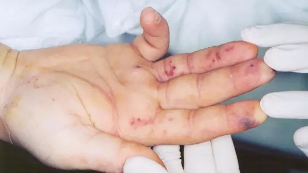 Nhận biết bệnh tim qua thay đổi ở tay